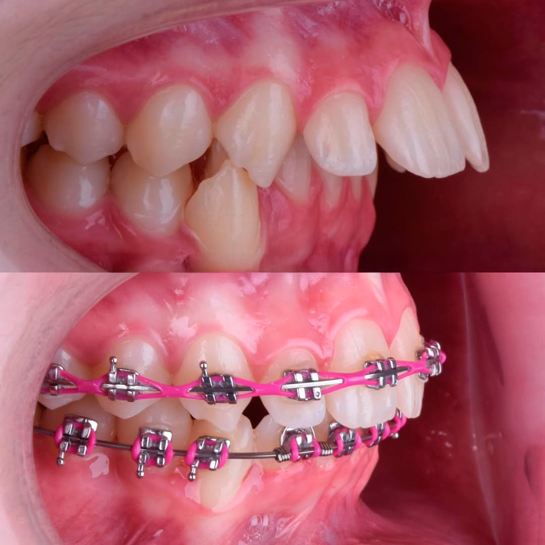 Ortodoncia & Brackets