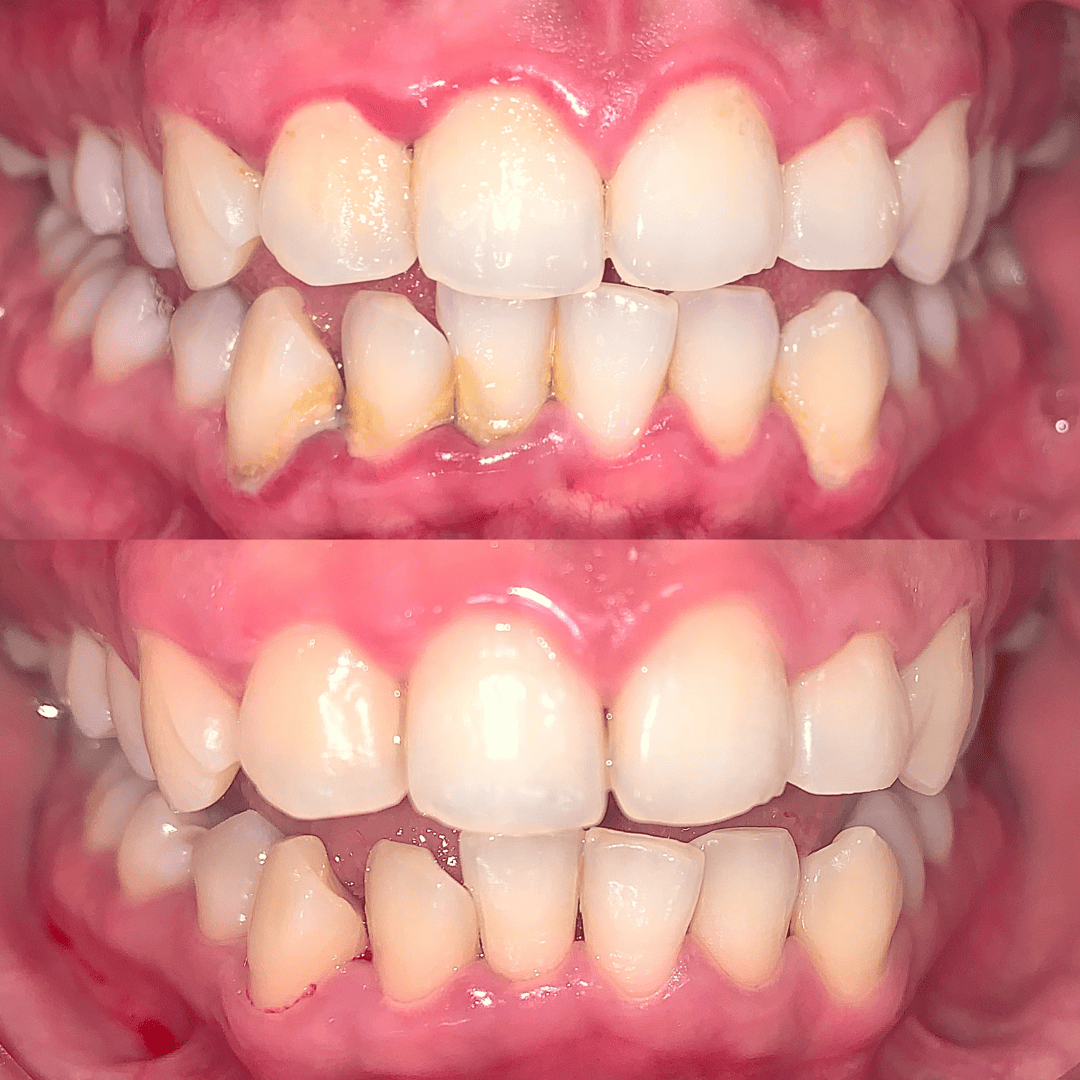 Blanqueamiento dental