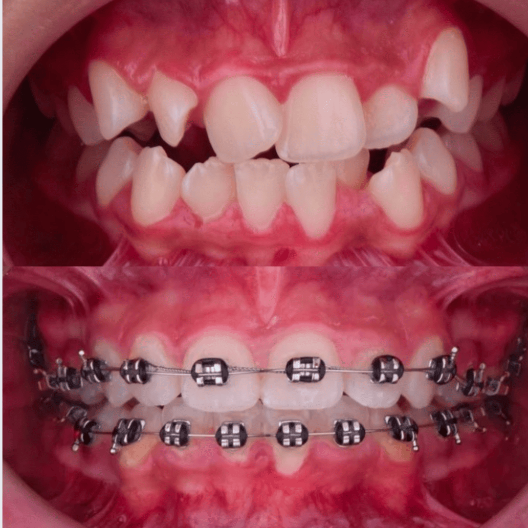 Ortodoncia & Brackets