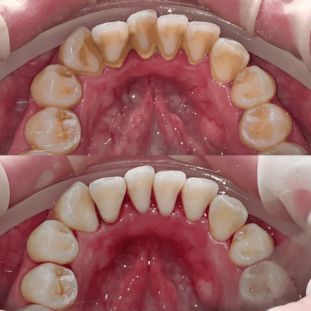 Blanqueamiento dental