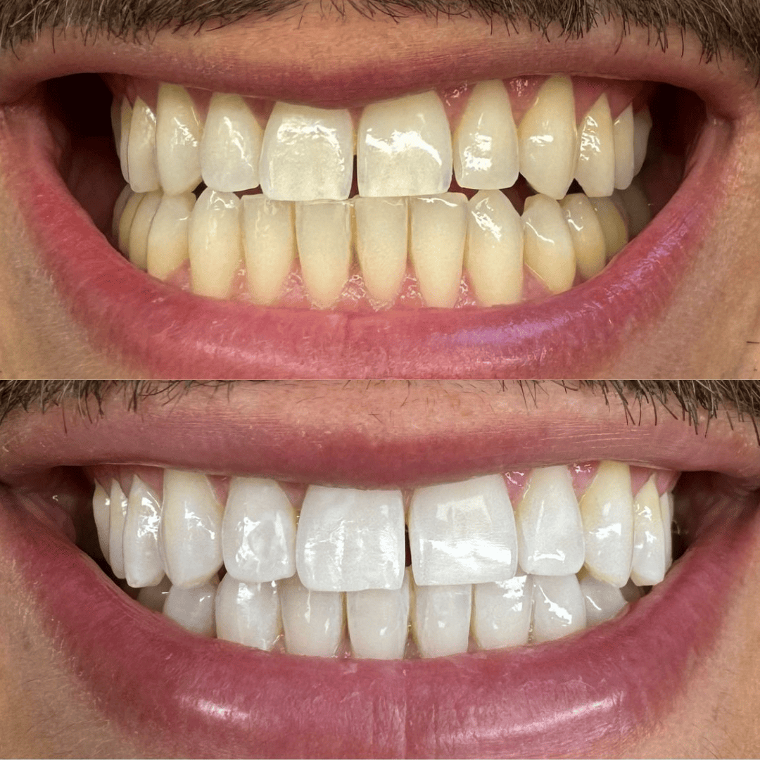 Blanqueamiento dental