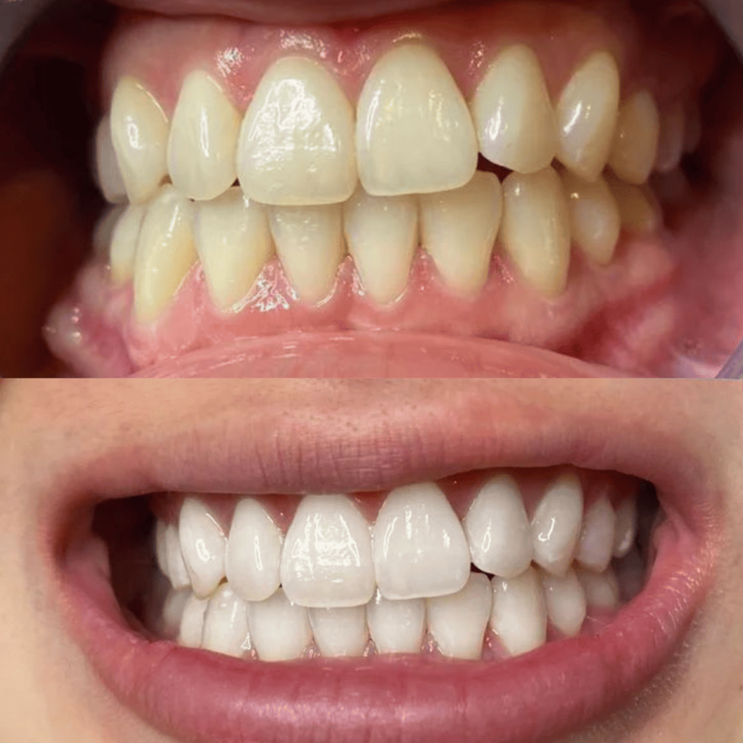 Blanqueamiento dental