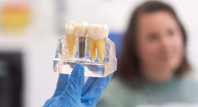 Implantes Dentales en Quito: Soluciones permanentes para tu sonrisa